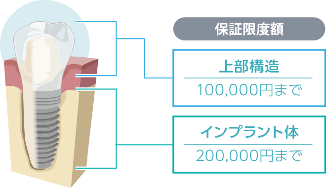 ガイドデント保証システム│インプラント保証ならガイドデント